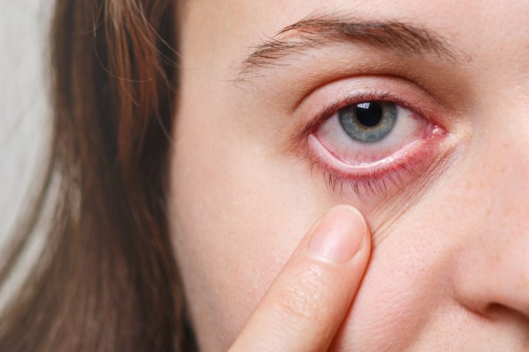 Konjungtivitis